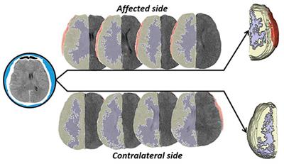 Evaluation of the prognosis of acute subdural hematoma according to the density differences between gray and white matter